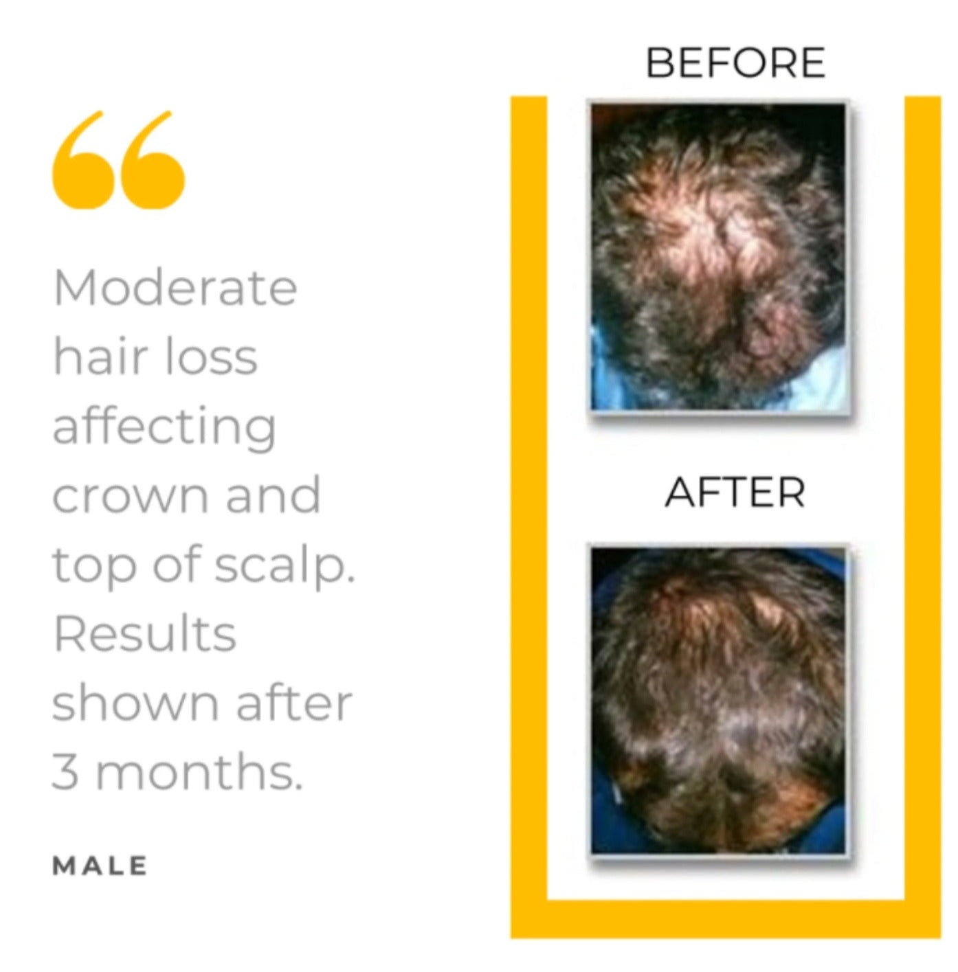 Hair Loss Defense 5-Piece Kit - 90 Day Supply