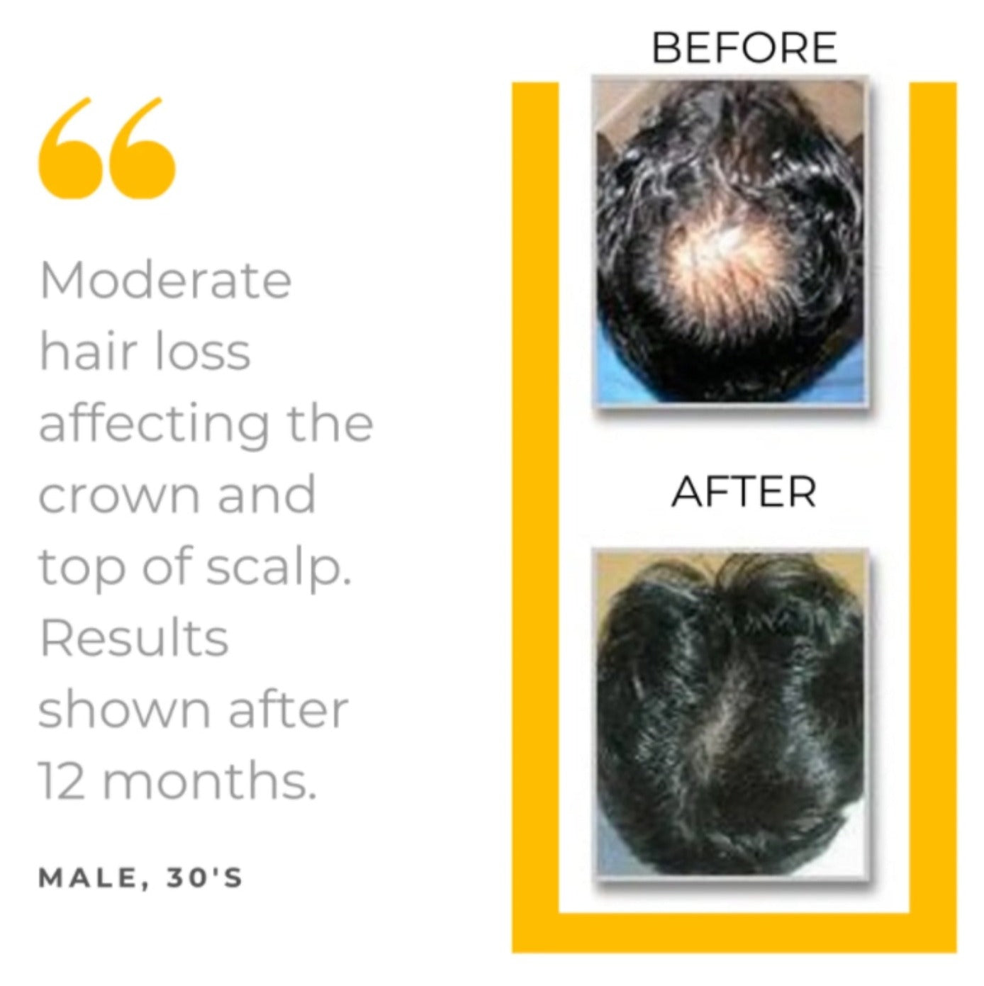 Hair Loss Defense 5-Piece Kit - 90 Day Supply