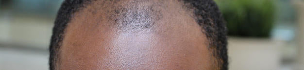 HOW LONG DOES IT TAKE TO LOSE YOUR HAIR WITH MALE PATTERN BALDNESS