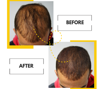90 -Day Hair Regrowth Scalp Therapy Kit
