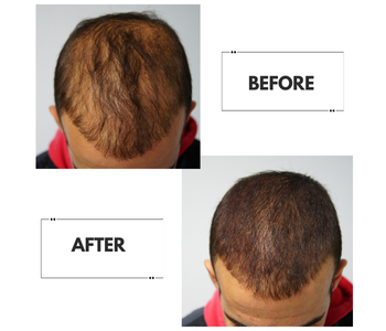 90 -Day Hair Regrowth Scalp Therapy Kit