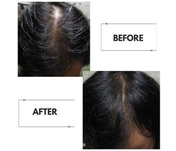 90 -Day Hair Regrowth Scalp Therapy Kit
