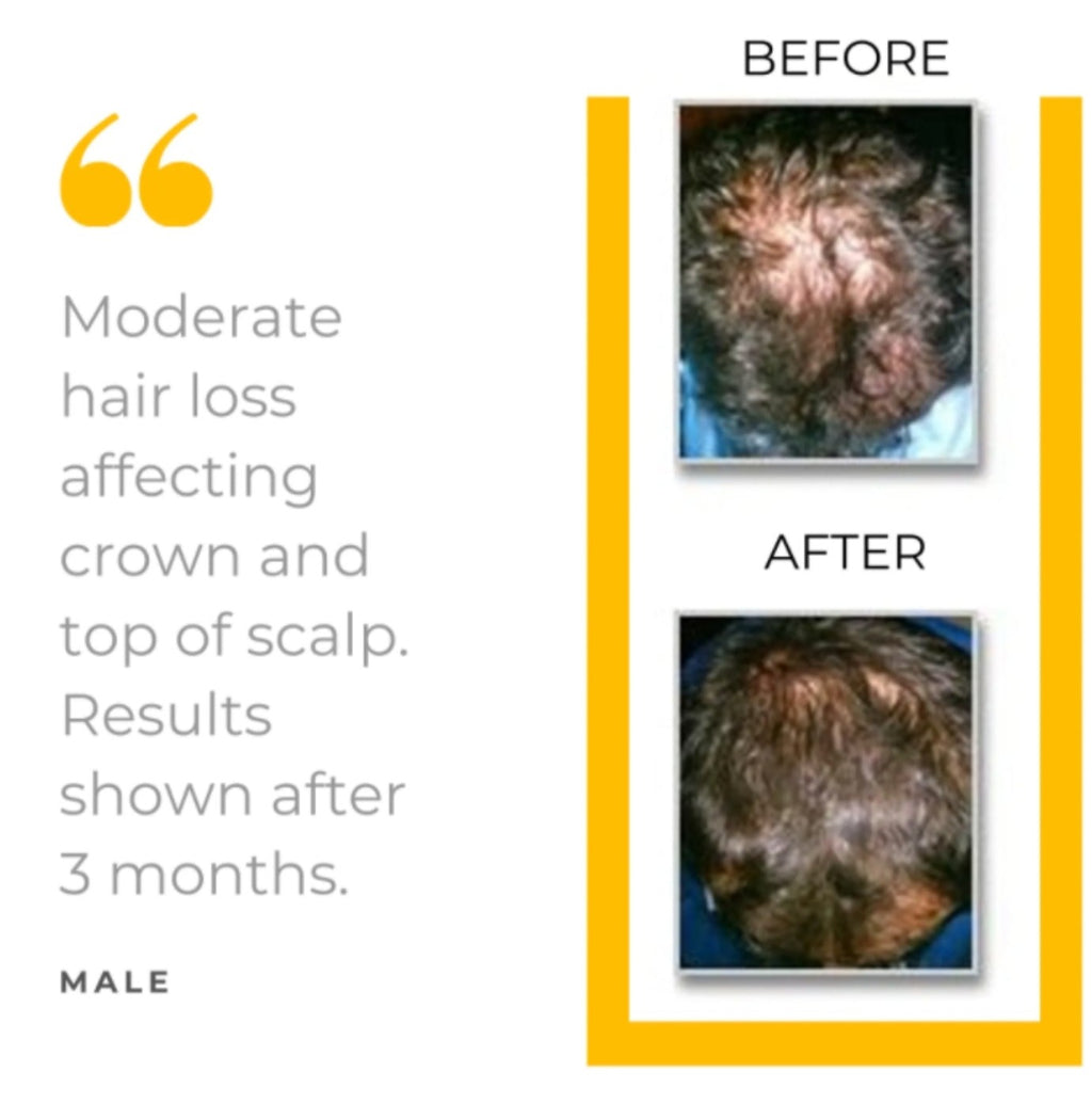 NEW! Hair Loss Defense 6-Piece Transition Starter Kit - 90 Day Supply