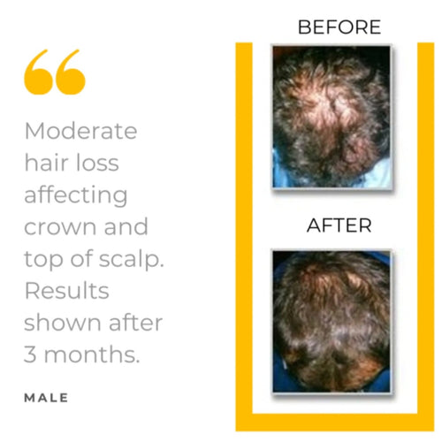 MD 90-Day Scalp Therapy Kit - SAVE 50%