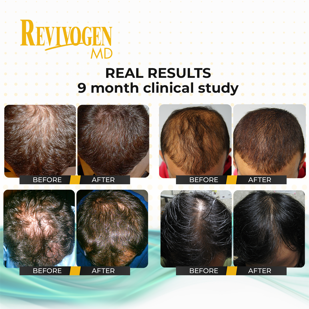 Kit de terapia capilar para el cuero cabelludo de 90 días