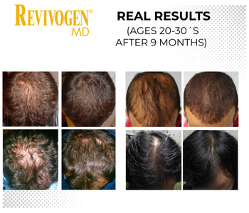 90 -Day Hair Regrowth Scalp Therapy Kit