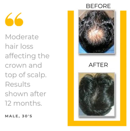 ¡NUEVO! Kit de transición de 6 piezas para la protección contra la caída del cabello (suministro para 90 días)