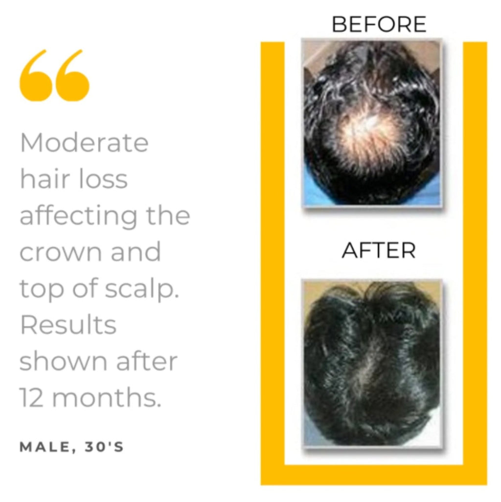 Kit de 5 piezas para la prevención de la caída del cabello (suministro para 90 días)